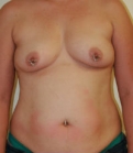 Feel Beautiful - Mommy Makeover San Diego Case 2 - Before Photo